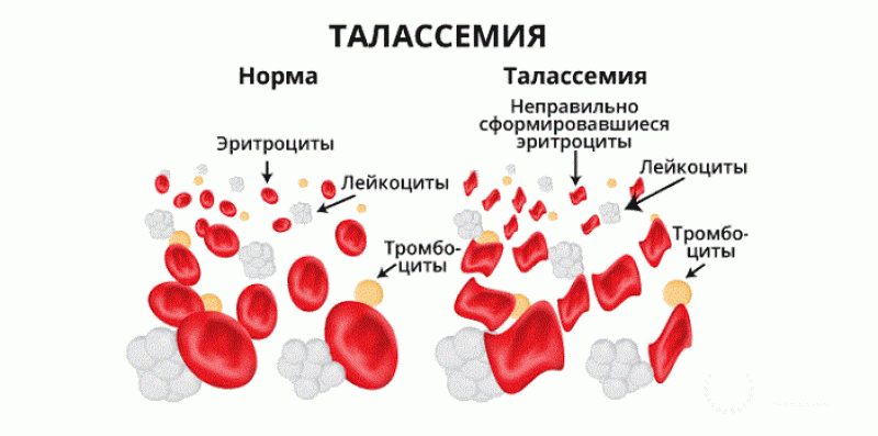 Талассемия - 1