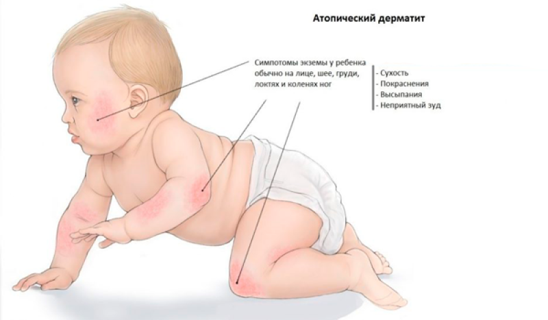 Атопический дерматит - 2