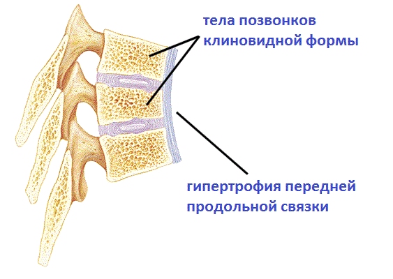 Клиновидные позвонки - 1