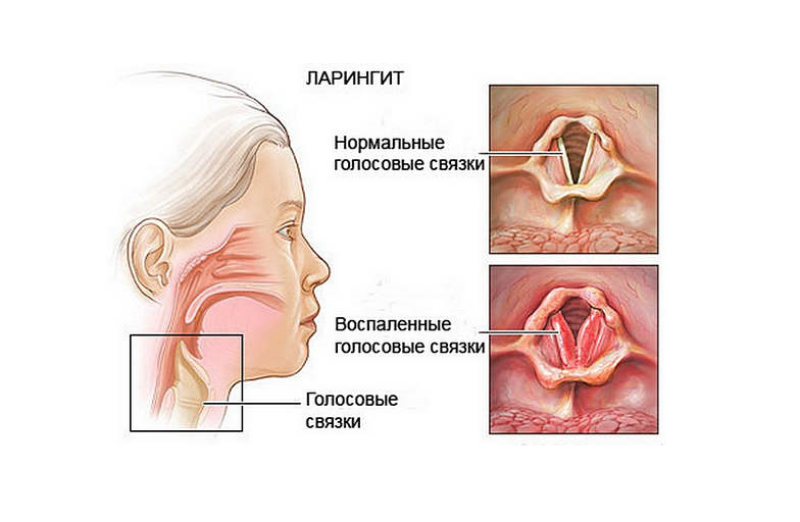 Ларингит - 2