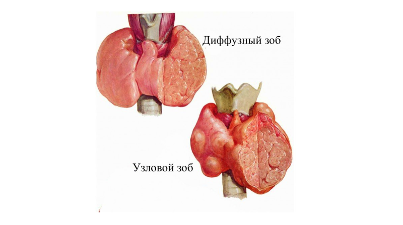Диффузный зоб - 2