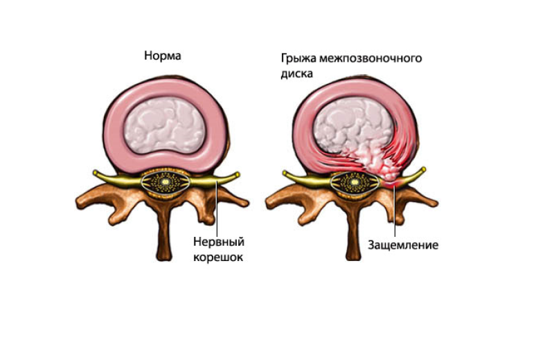 Грыжа межпозвоночного диска фото
