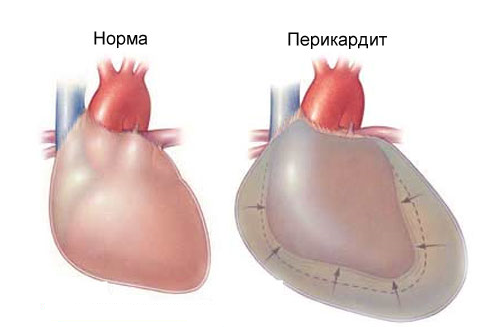 Экссудативный перикардит - 1