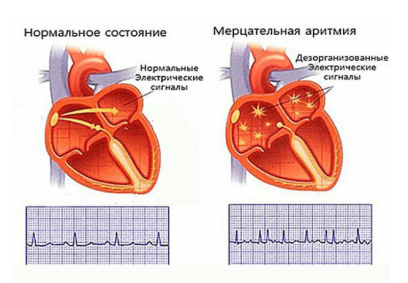 Мерцательная аритмия - 1