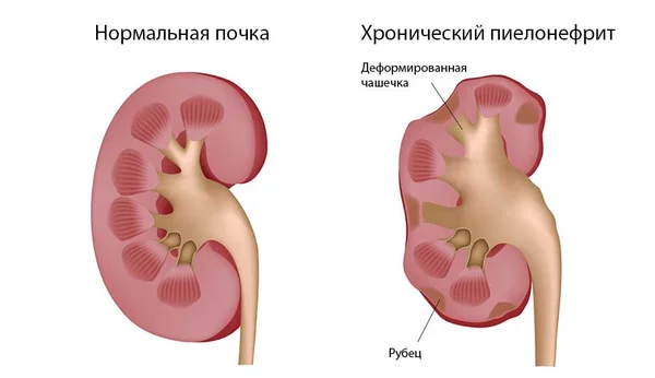 Хронический пиелонефрит - 1