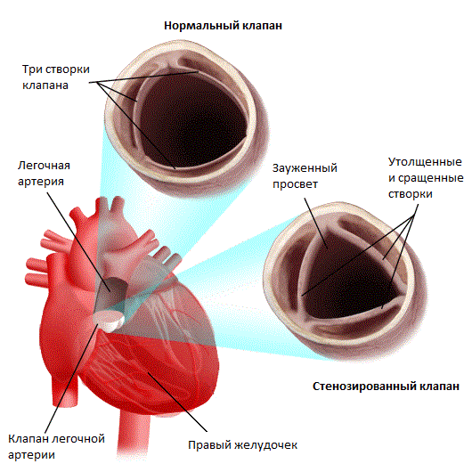 Стеноз устья легочной артерии - 1