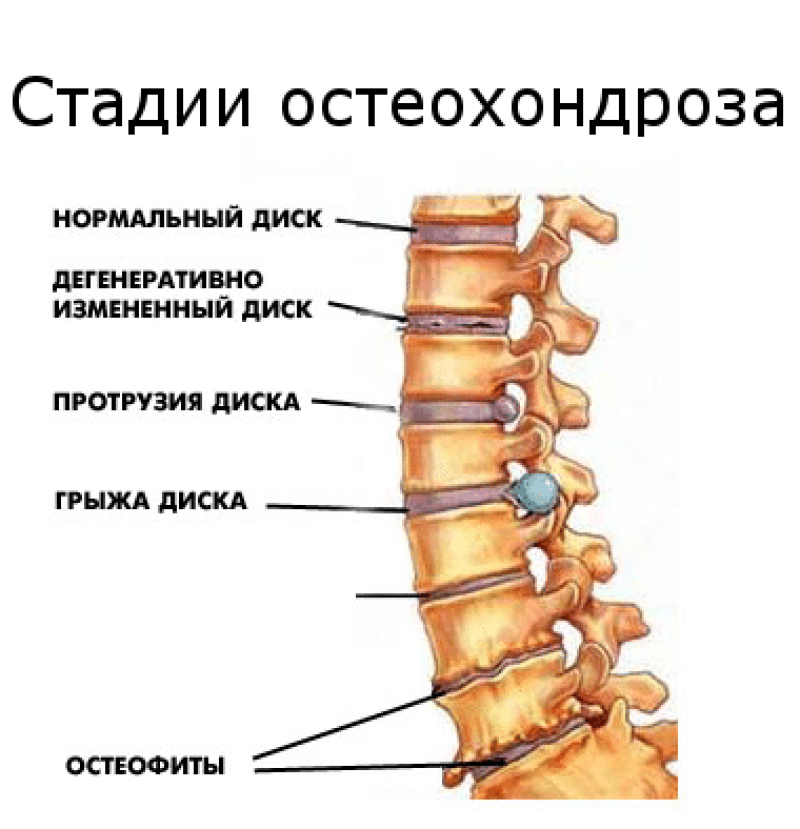 Протрузия дисков позвоночника и грыжа диска. Остеохондроз поясничного отдела периоды. Остеохондроз с1 с2 позвонка шейного отдела позвоночника. Классификация остеохондроза поясничного отдела позвоночника.