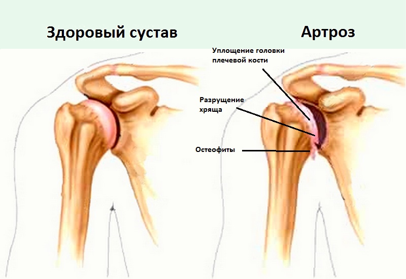 Артроз артрит плечевого сустава симптомы