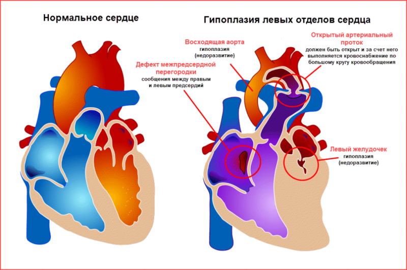 Синдром гипоплазии левых отделов сердца - 1
