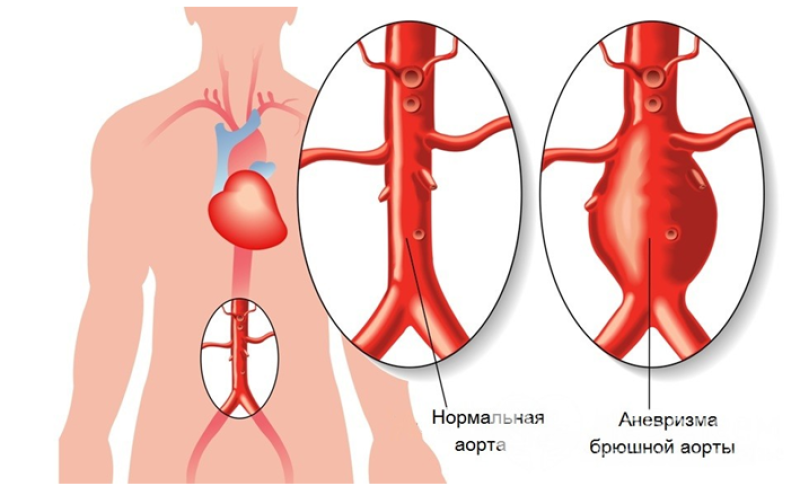 Расслаивающая аневризма аорты - 2