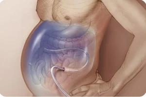 Причины скапливания жидкости в брюшной полости и методы лечения