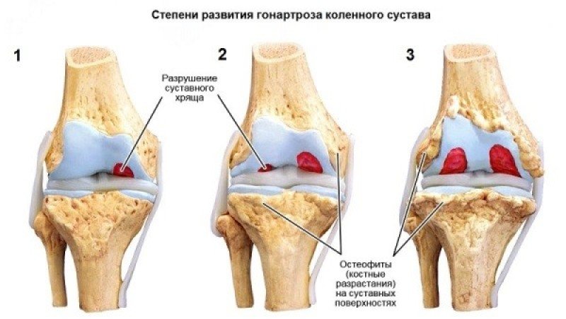 Деформирующий остеоартроз коленного сустава - 2