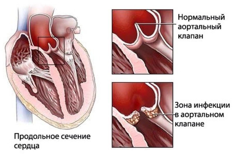 Ревматизм сердца - 2