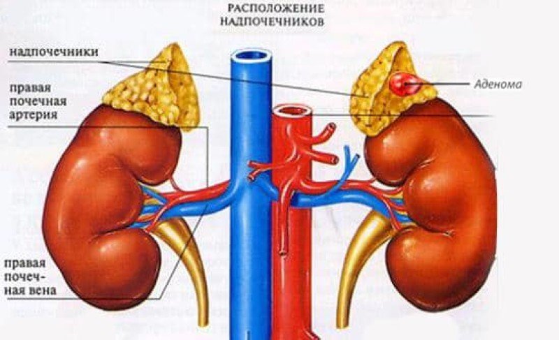 Киста надпочечника - 1