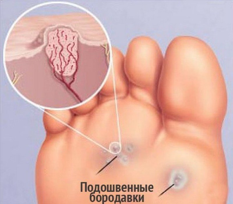 Бородавки подошвенные - 1