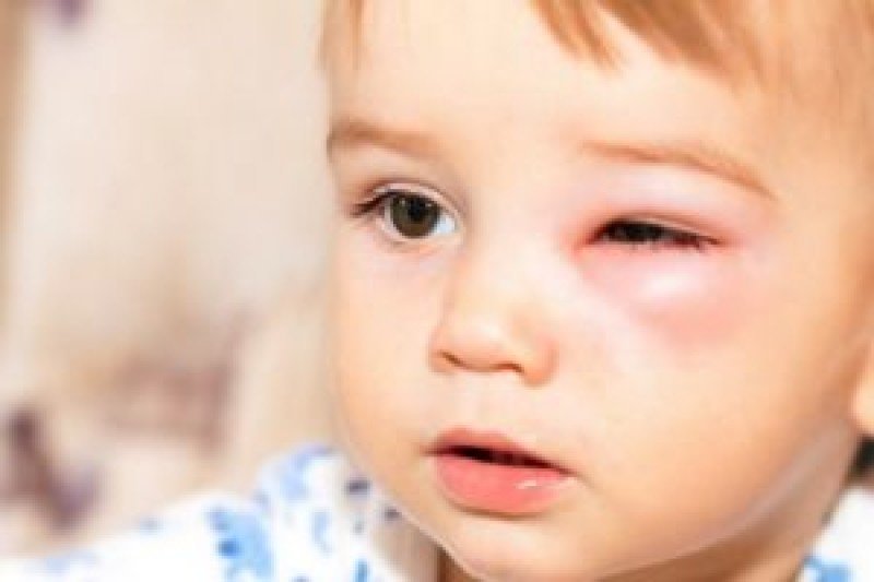 Причины и симптомы ячменя у ребенка 2 года