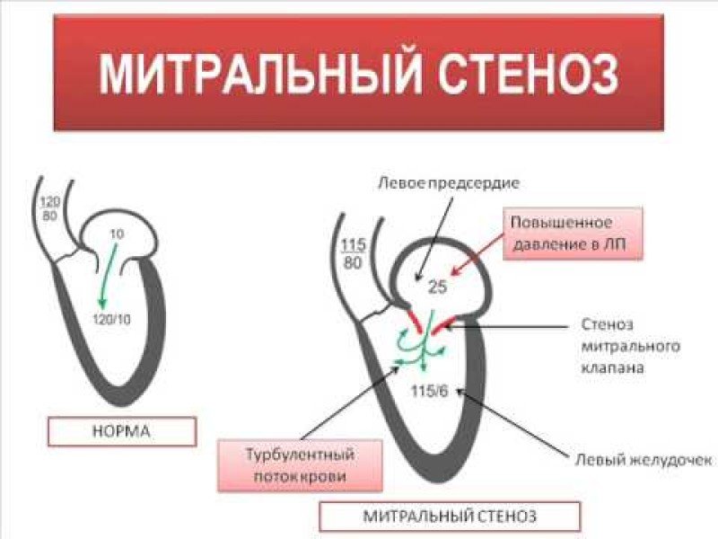 Гемодинамика митральный стеноз схема