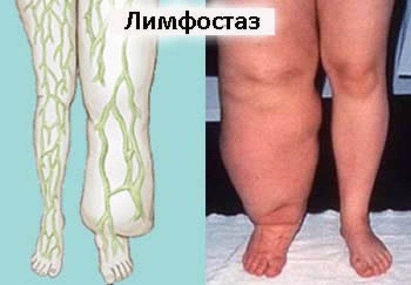 Лечение лимфостаза нижних конечностей - причины, симптомы многопрофильная клиника 