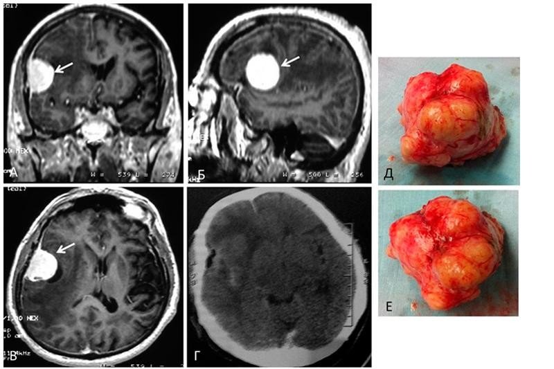 Опухоль мозга фото