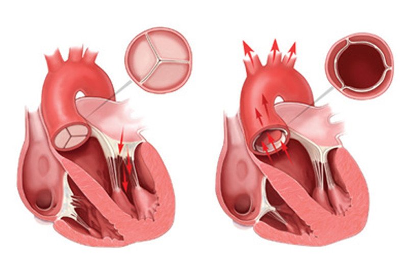 Митральный аортальный стеноз. Аортальный клапан сердца. Недостаточность аортального клапана. Порок сердца двухстворчатый аортальный клапан. Недостаточность створок аортального клапана.