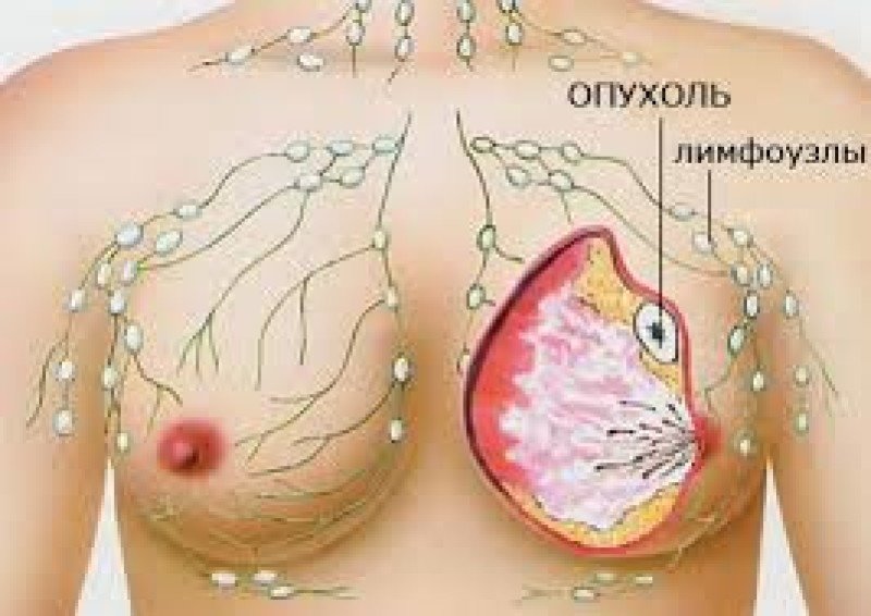 Рак молочной железы - 2