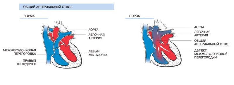 Общий артериальный ствол - 1