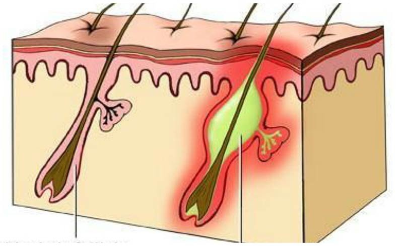 Фурункулез - 2