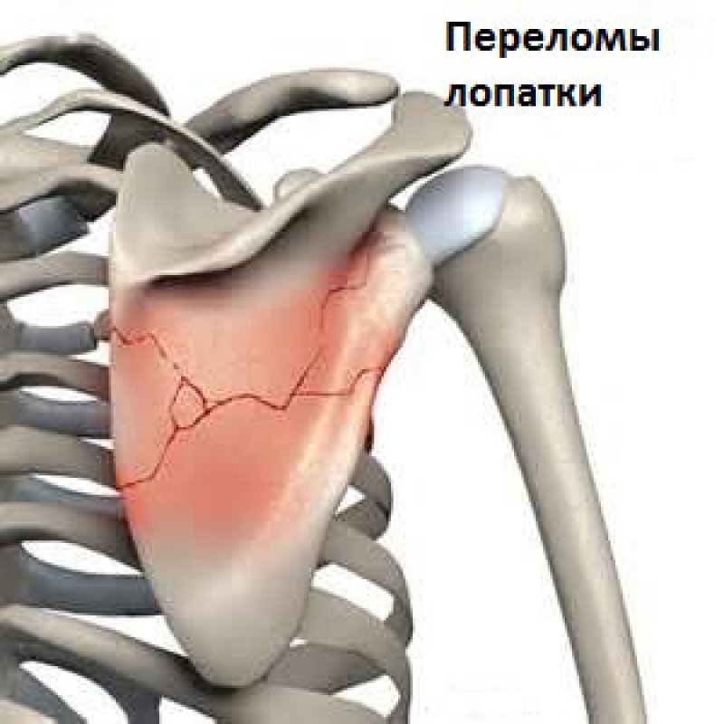 Перелом лопатки. Оскольчатый перелом лопатки. Перелом акромиона лопатки симптомы. Перелом суставной поверхности лопатки. Многооскольчатый перелом лопатки.