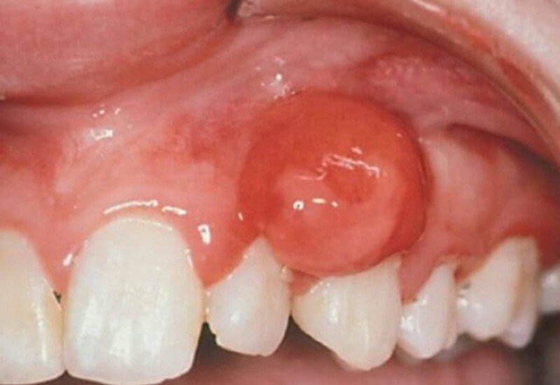 Фиброма полости рта (фпр) - 1