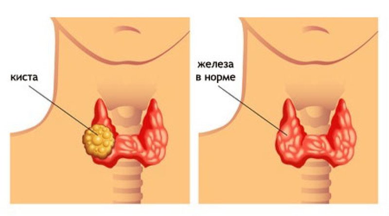 Киста щитовидной железы - 1