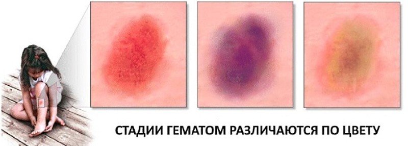 Гематома на лице: как избавиться от гематомы в домашних условиях