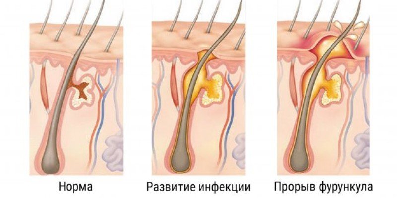 Фурункул - 2