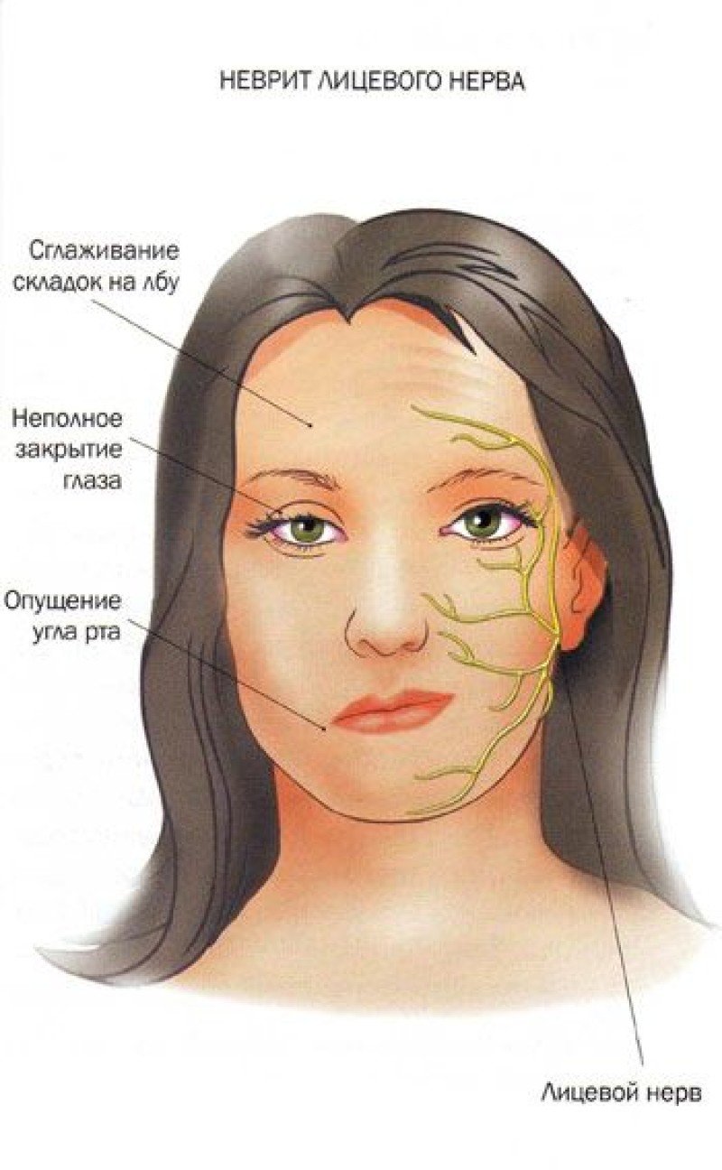 Воспаление лицевого нерва