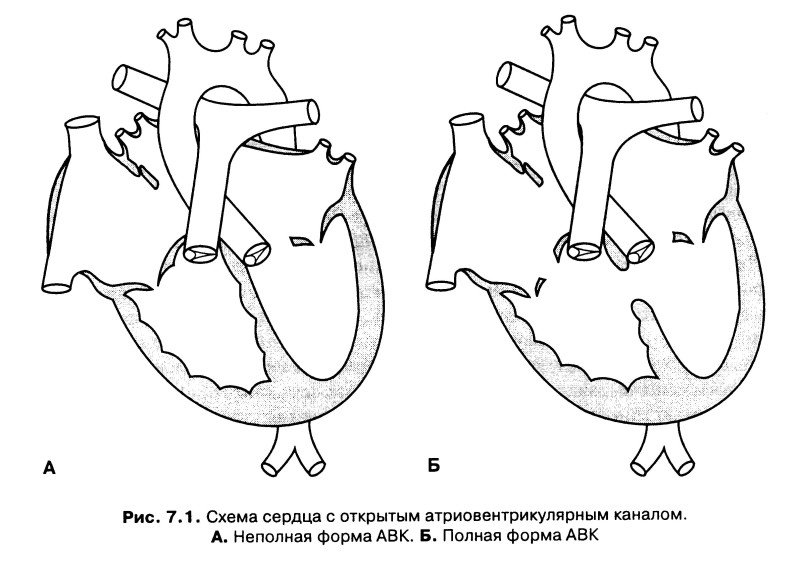 Открытый атриовентрикулярный канал - 2
