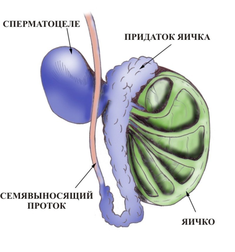 Сперматоцеле - 1