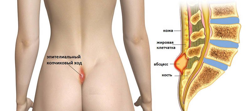 Эпителиальный копчиковый ход - 2