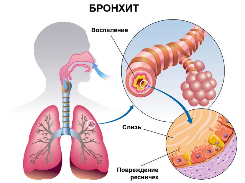 Бронхит - 1