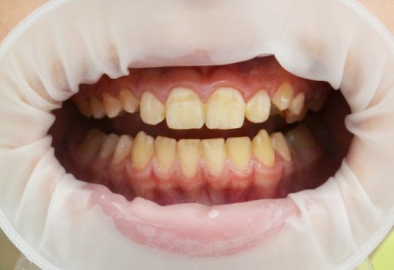 Зубной налет - 1