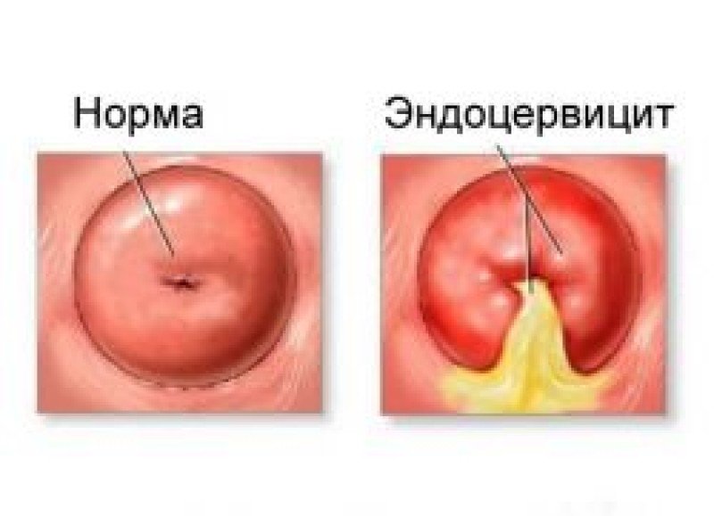 Эндоцервицит (эц) - 1