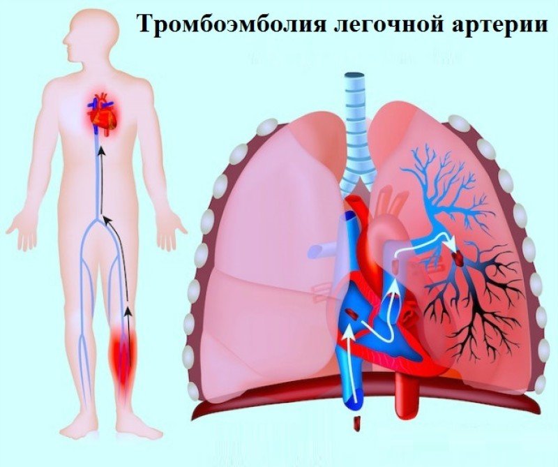Тромбоэмболия легочной артерии.Симптомы и лечение.