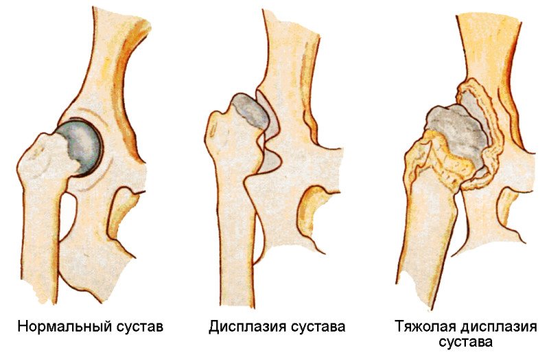 Дисплазия суставов - 1