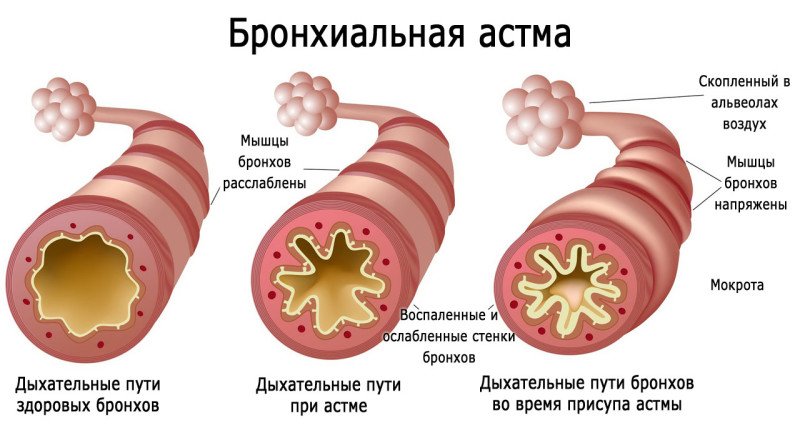 Бронхиальная астма - 2