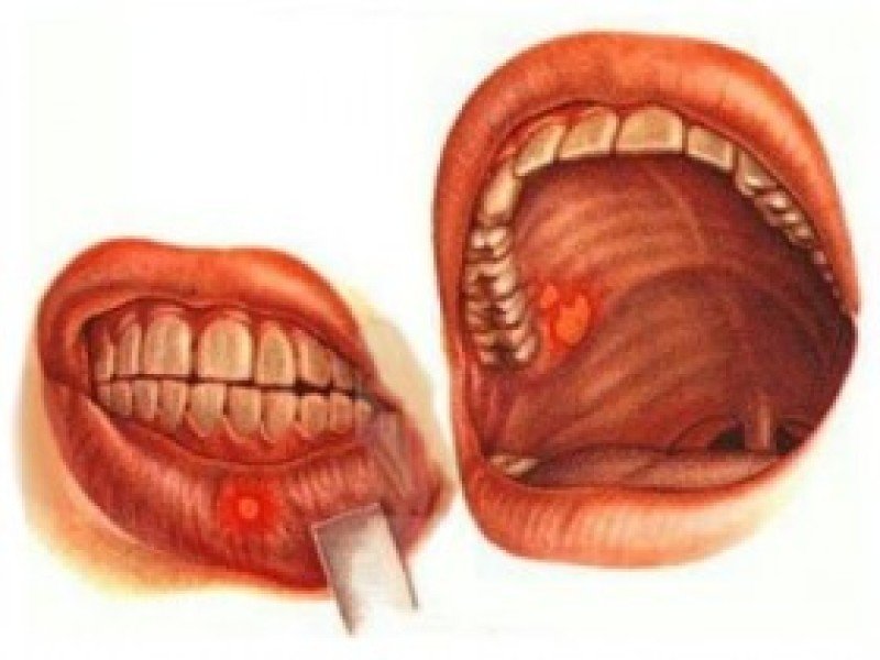 Рак полости рта - 1