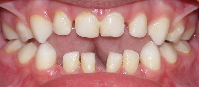 Дефекты зубных рядов - 1