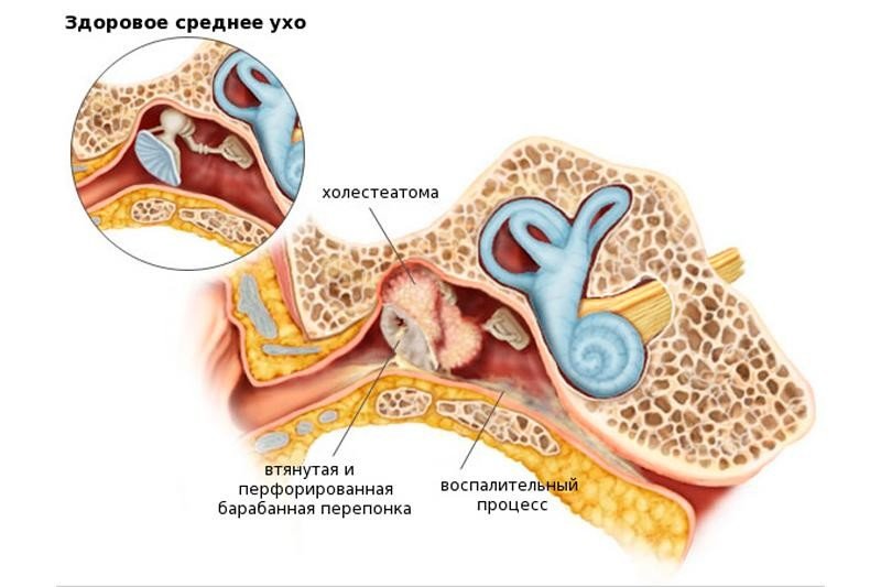 Холестеатома уха - 1