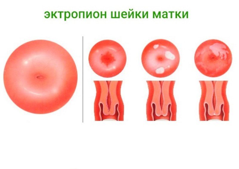 Эктопия это. Эрозированный эктропион. Эрозия и эктропион матки. Эрозия эктопия эктропион.