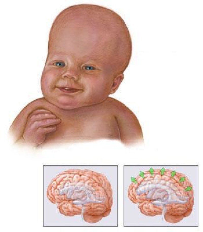 Гидроцефалия у ребенка фото