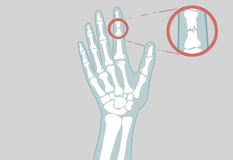 Как определить перелом пальца