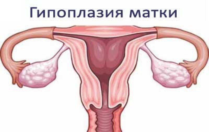 Гипоплазия матки - 1