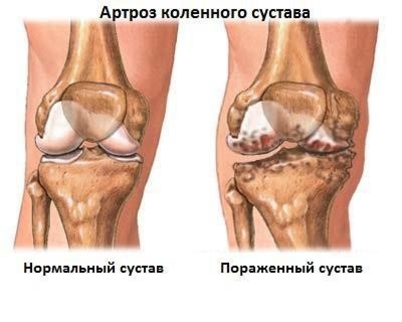 Деформирующий остеоартроз коленного сустава - 1